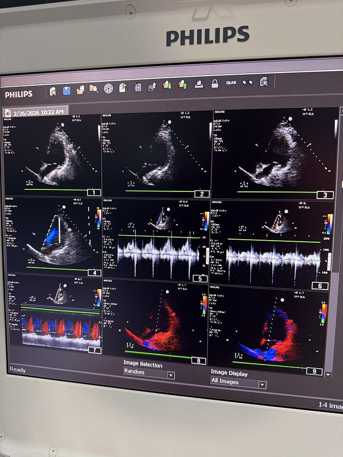Gebraucht Philips CX50 Ultraschallgerät mit Sonde S5-1 auf Trolley