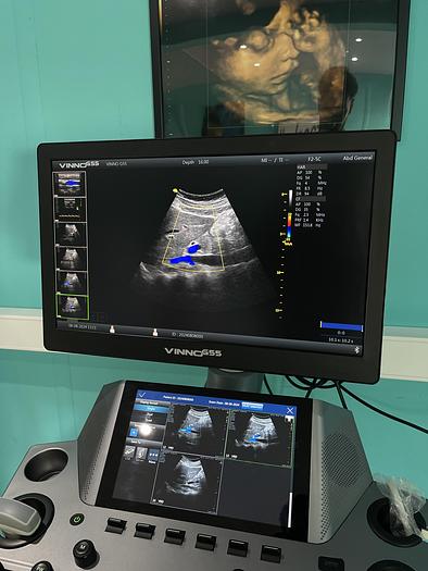 Used Vinno G55 Ultraschallgerät mit Konvex Sonde