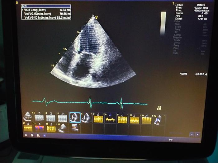 Gebraucht GE Vivid E9 Ultraschallgerät mit MS5-D Kardiosonde