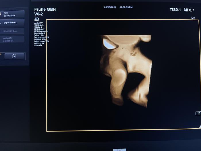 Gebraucht Philips V6-2 3D/4D Volumen Ultraschallsonde