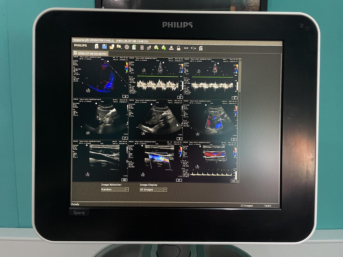 Gebraucht Philips Sparq Ultraschallgerät mit drei Sonden und Drucker