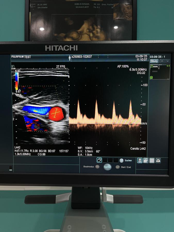Gebraucht Hitachi ALOKA Arietta 65 Ultraschallgerät mit zwei Sonden
