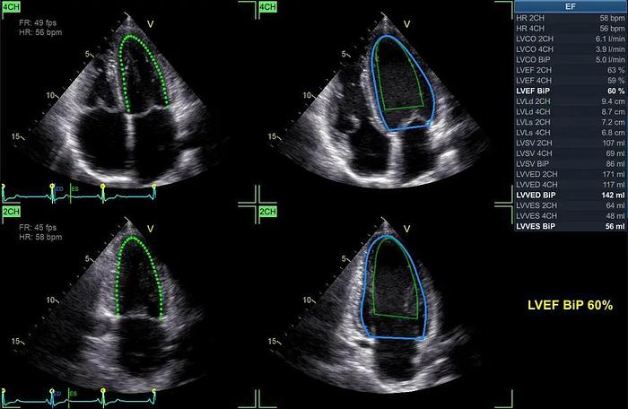 Überholt GE Vivid iq tragbares kardiologisches Ultraschallgerät