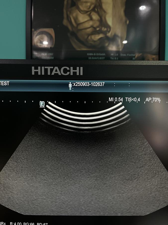 Gebraucht Hitachi ALOKA Arietta 65 Ultraschallgerät mit zwei Sonden