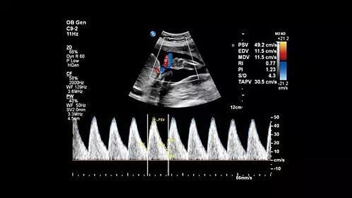 Philips Affiniti 70 Farbdoppler Ultraschallgerät