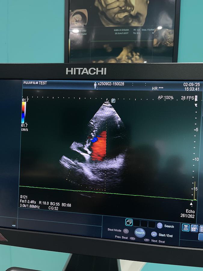 Gebraucht Hitachi ALOKA Arietta 850 Ultraschallgerät mit zwei Sonden und Drucker