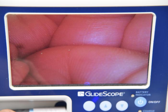 VERATHON GLIDESCOPE 0231-0003 GVL WITH MONITOR, ADULT 3-4 BATON 0570-0185 AND POWER CABLE