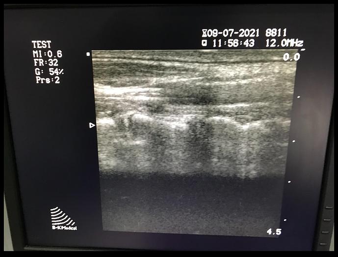 Gebraucht BK Medical 2101 Falcon Ultraschallgerät mit 3 Sonden und Sony Drucker