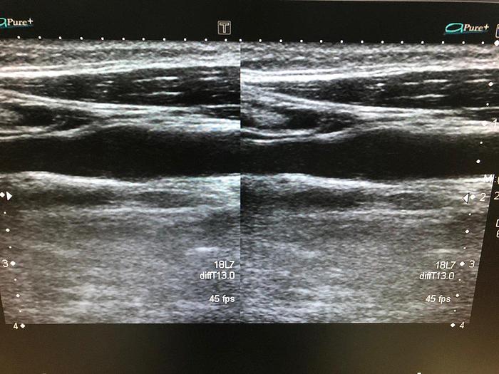 Gebraucht Toshiba PLT-1204BT Lineare Sonde