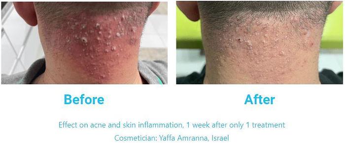 Dr. Platon Ultra Plasma System