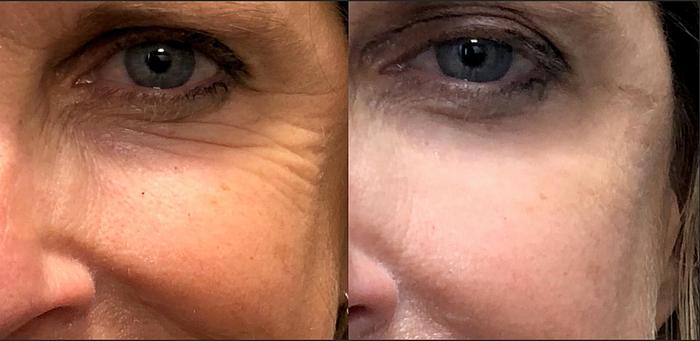 Reflections Pro Formula - Smooth 2 in 1 Instant Lift and Long Term Results