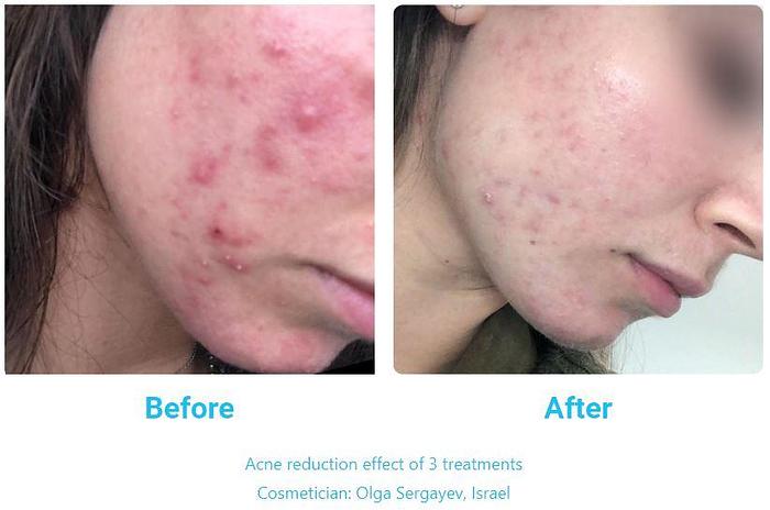 Dr. Platon Ultra Plasma System