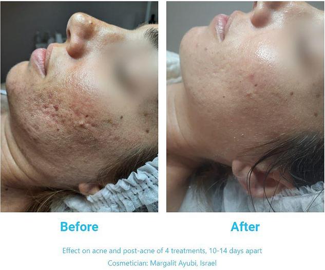 Dr. Platon Ultra Plasma System