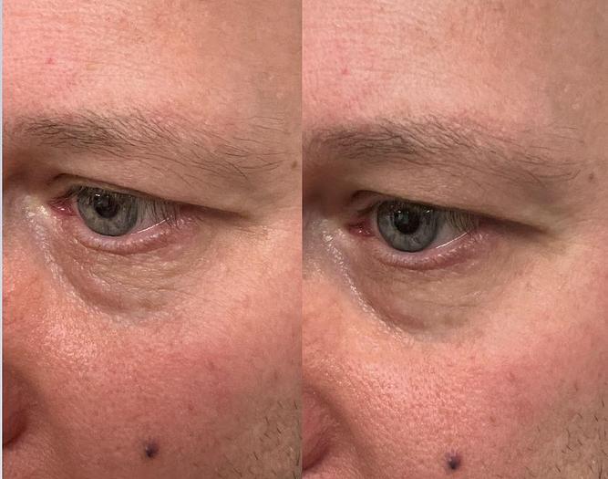 Reflections Pro Formula - Smooth 2 in 1 Instant Lift and Long Term Results