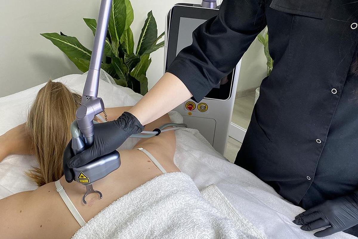 SkinGlow CO2 Fractional