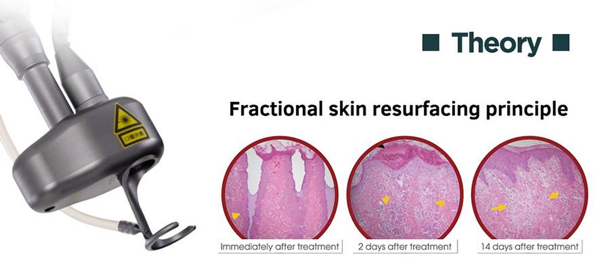 SkinGlow CO2 Fractional