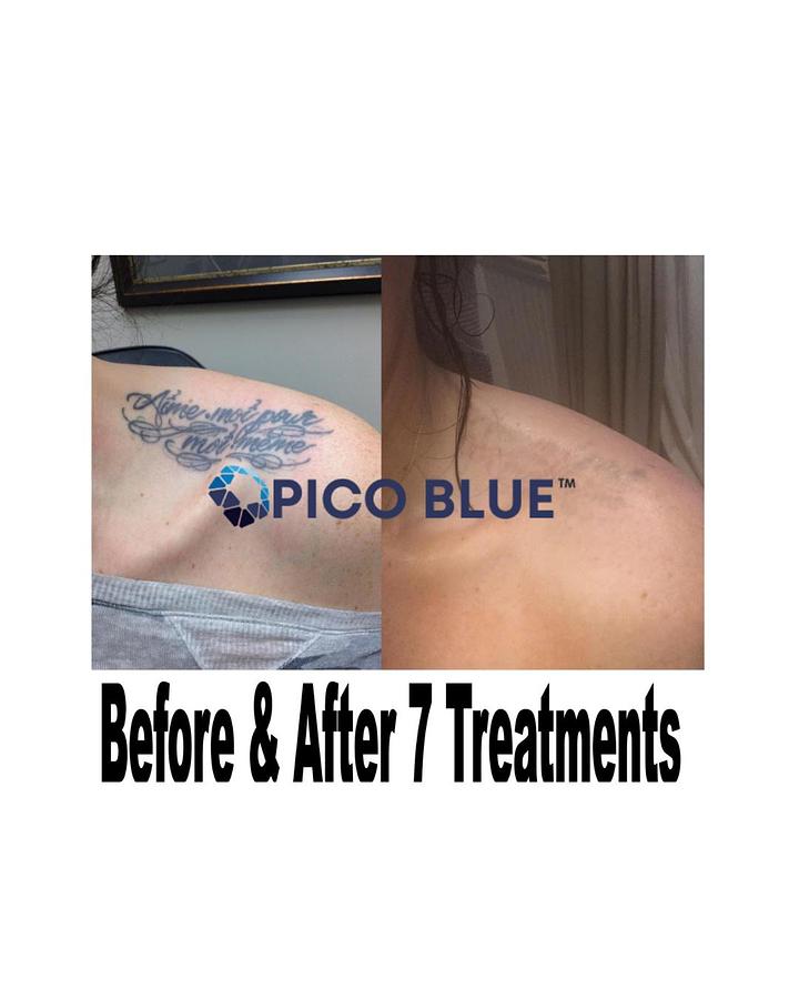Pico Blue Portable Q Switch Tattoo Removal