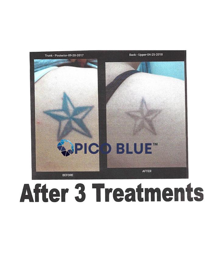 Pico Blue Portable Q Switch Tattoo Removal