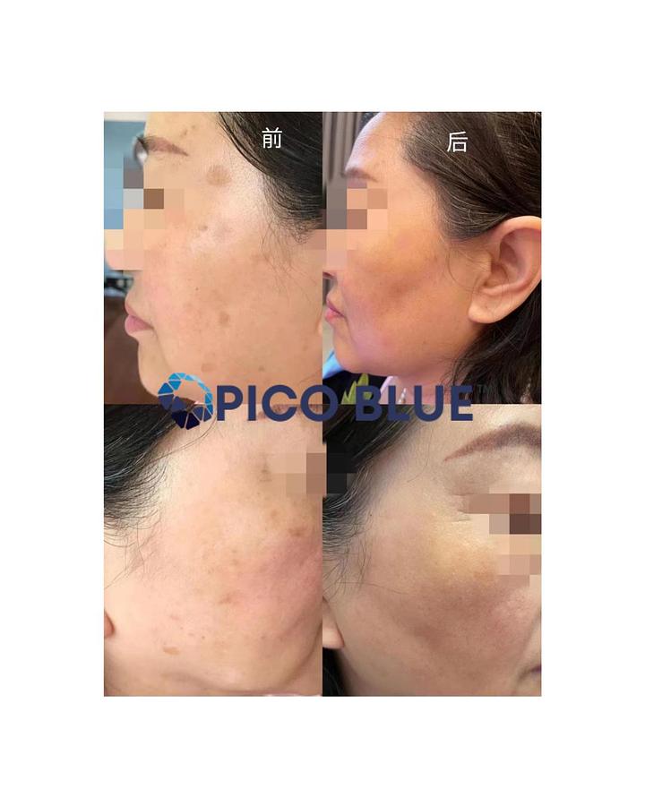 Pico Blue Portable Q Switch Tattoo Removal