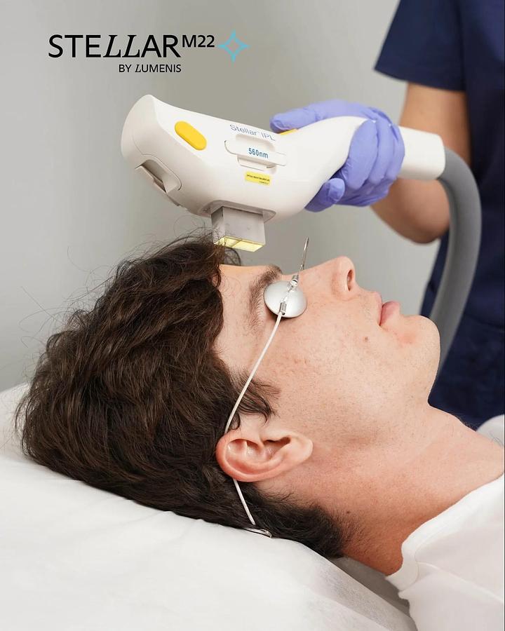 Lumenis Stellar M22 New IPL Hand Piece - 1 Year Warranty