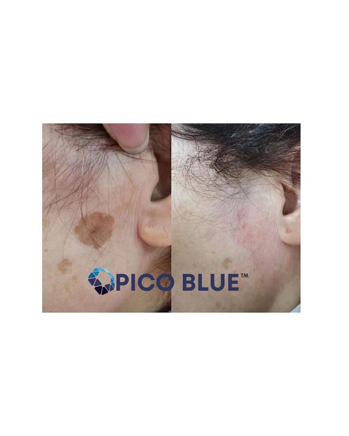 Pico Blue Portable Q Switch Tattoo Removal