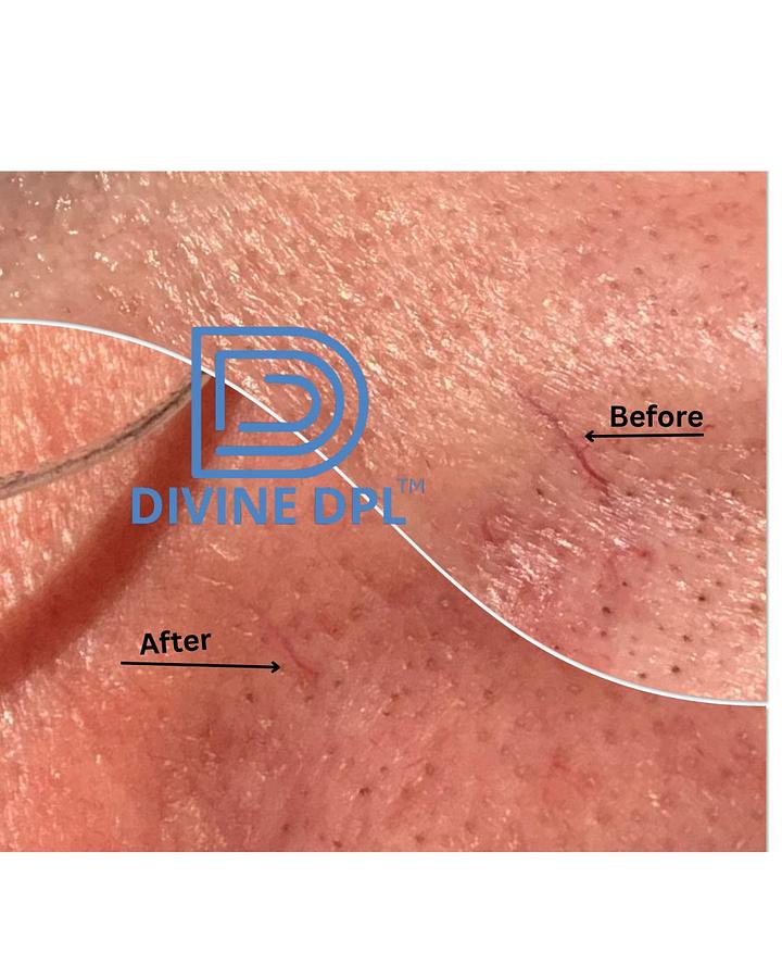 Divine Portable DPL Device (IPL)