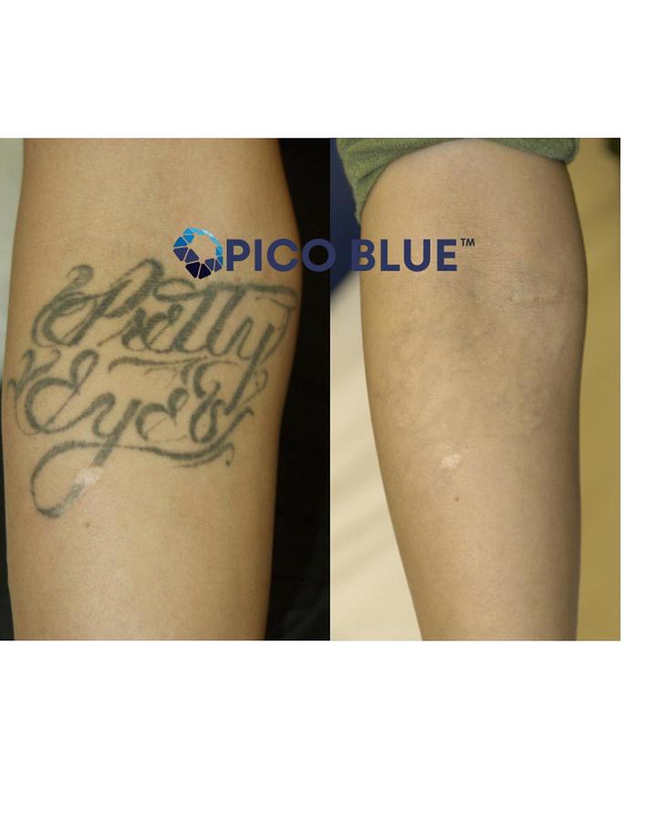 Pico Blue Portable Q Switch Tattoo Removal