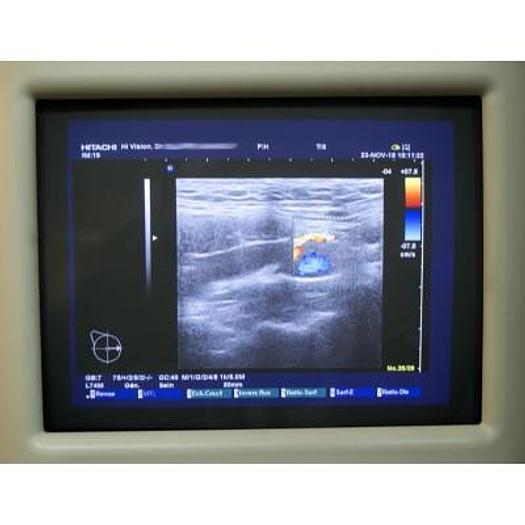 D'occasion ECHOGRAPHE HITACHI PLATEFORME HI VISION PREMIUM AVEC 3 SONDES