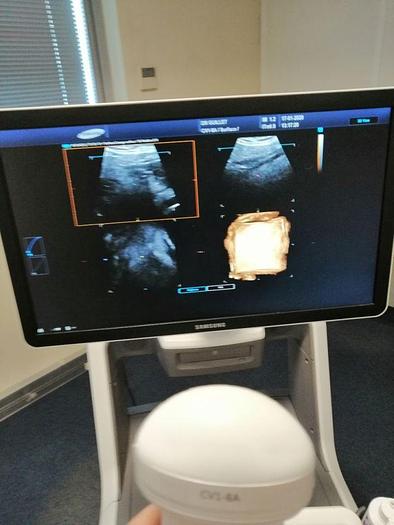 Used SAMSUNG/MEDISON ACCUVIX A35