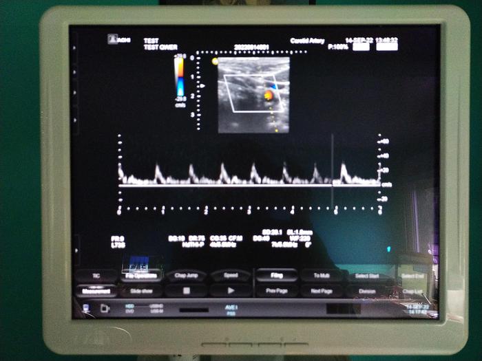 Gebraucht Hitachi Hi Vision Preirus Ultraschallgerät inkl. 3 Sonden, 