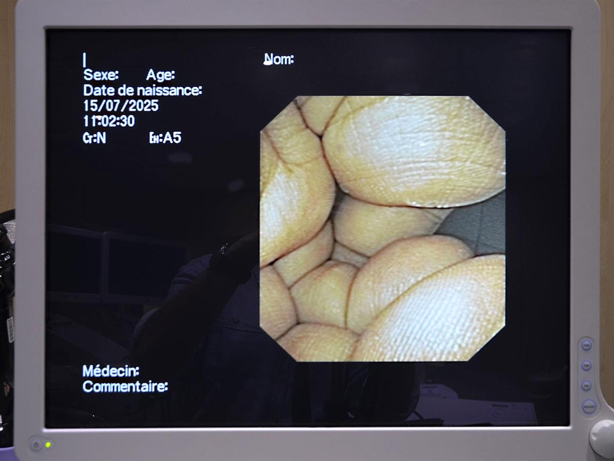 D'occasion VIDEO GASTROSCOPE PAR VOIE NASALE OLYMPUS GIF-N180