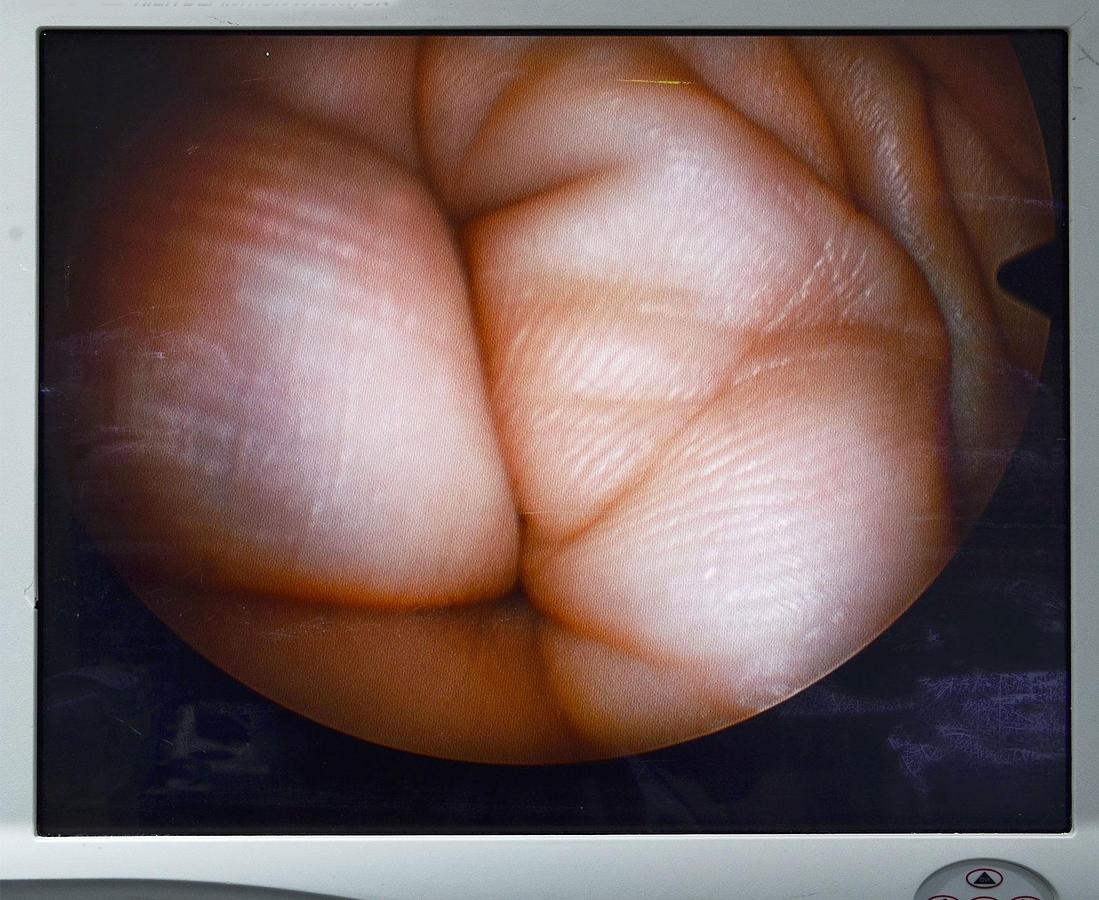 D'occasion ENSEMBLE D' ARTHROSCOPIE CONSTITIÉ D'UNE OPTIQUE R. WOLF 8880.531 O° PANOVIEW AVEC SET DE PINCES ET DE RONGEURS