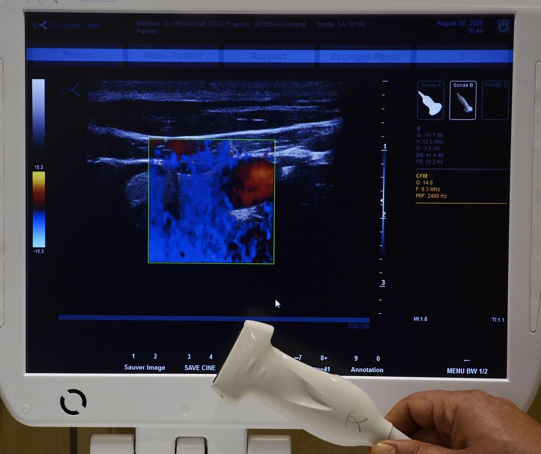 D'occasion ECHOGRAPHE SONOSCANNER ORCHEO LITE PORTABLE