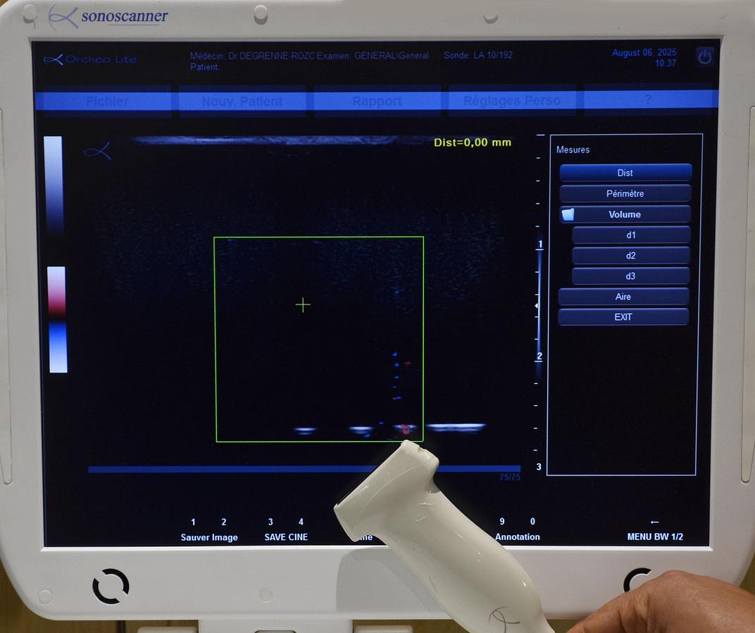 D'occasion ECHOGRAPHE SONOSCANNER ORCHEO LITE PORTABLE