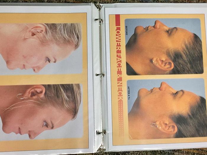 Used 2014 BTL Exilis Elite Body Contouring and wrinkle reduction