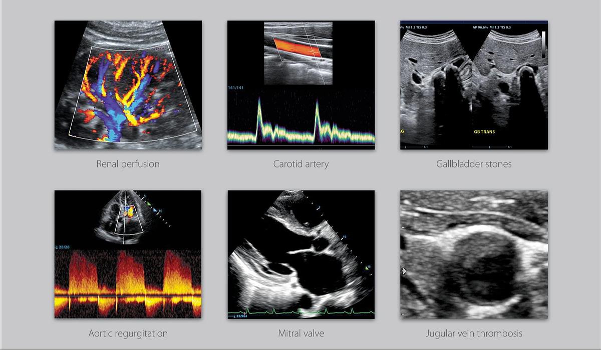 Mindray M8 Elite Renal Perfusion, Carotid Artery, Gallbladder Stones, Aortic Regurgitation, Mitral Valve, Jugular Vein Thrombosis Scans