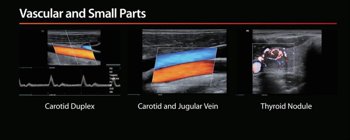 Mindray Mx7 Advanced CV Ultrasound Machine for Sale Vascular Scan Images