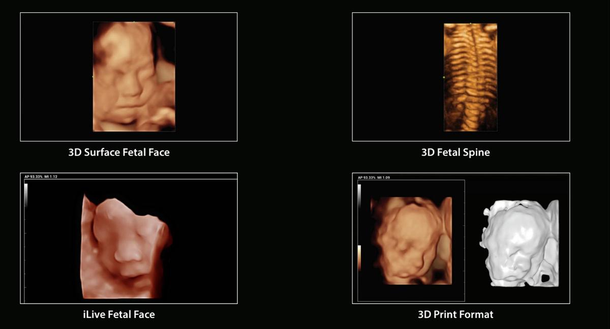 High Resolution Fetal Scans 3D/4D Probe Mindray MX7 Ultrasound Machine For Sale Manifest Medical