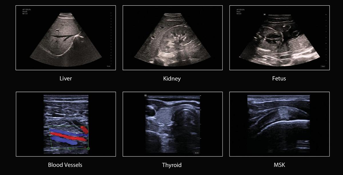 Liver, Kidney, Fetus, Blood Vessels, Thyroid, MSK scans for Mindray TE Air E5M