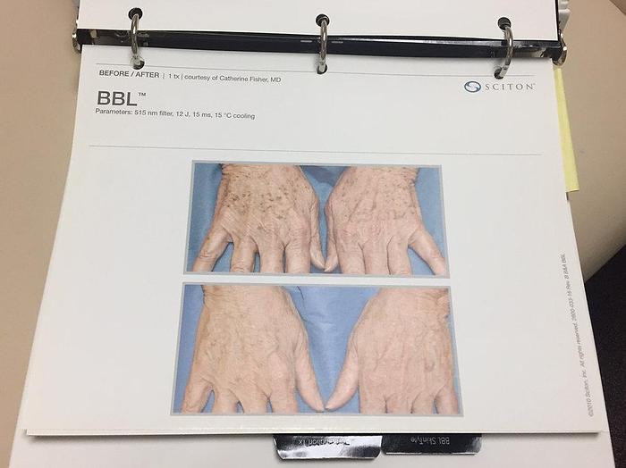 Used 2013 Sciton BBLs w/ Skin Tyte II