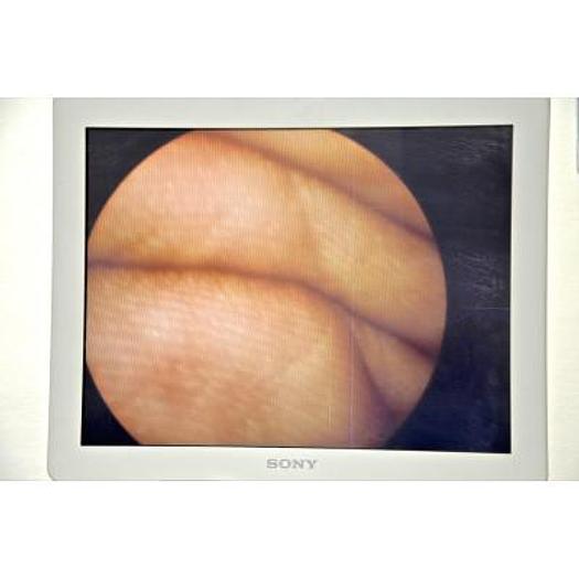 D'occasion COLONNE DE COELIOCHIRURGIE RICHARD WOLF AVEC CAMERA 3CDD