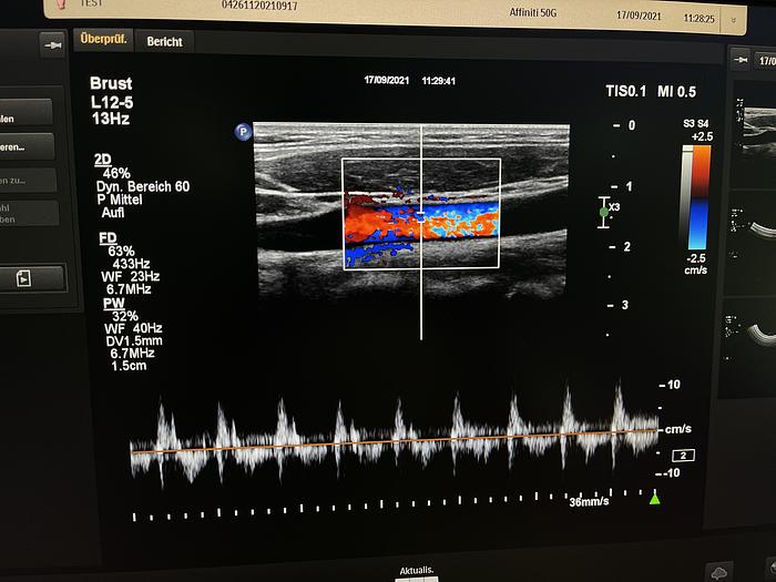 Gebraucht Philips Affiniti 50G Ultraschallgerät mit Sony Drucker
