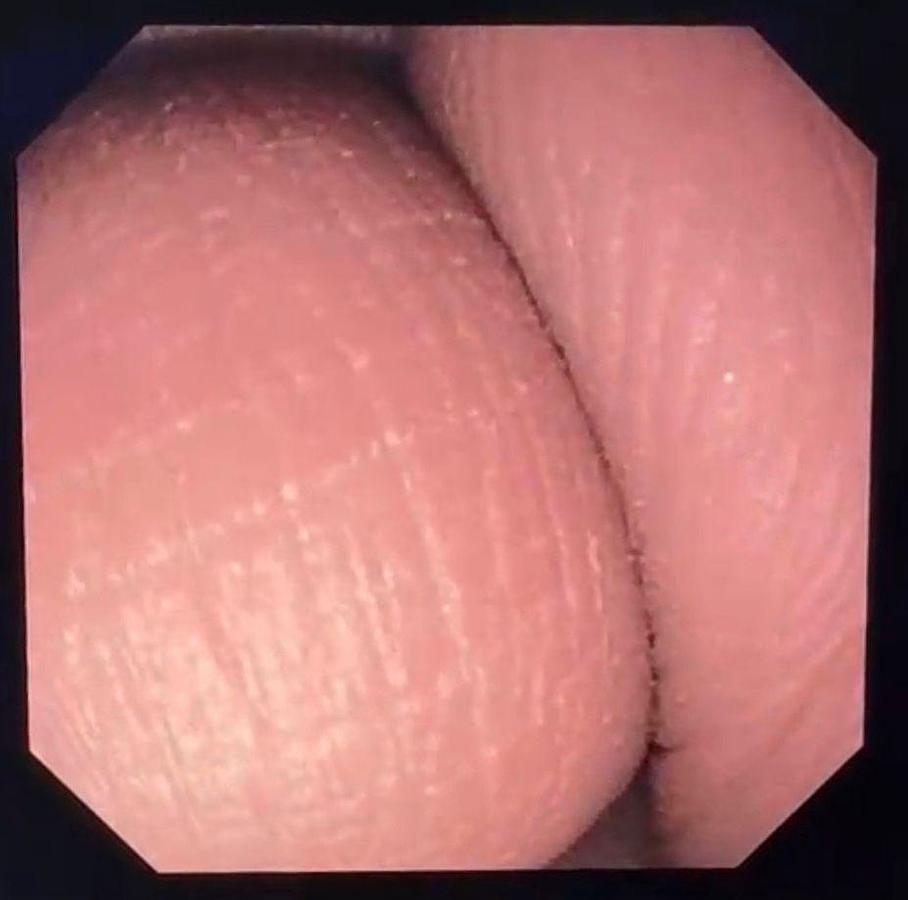 Used Olympus Scope Model: TJF-Q190V