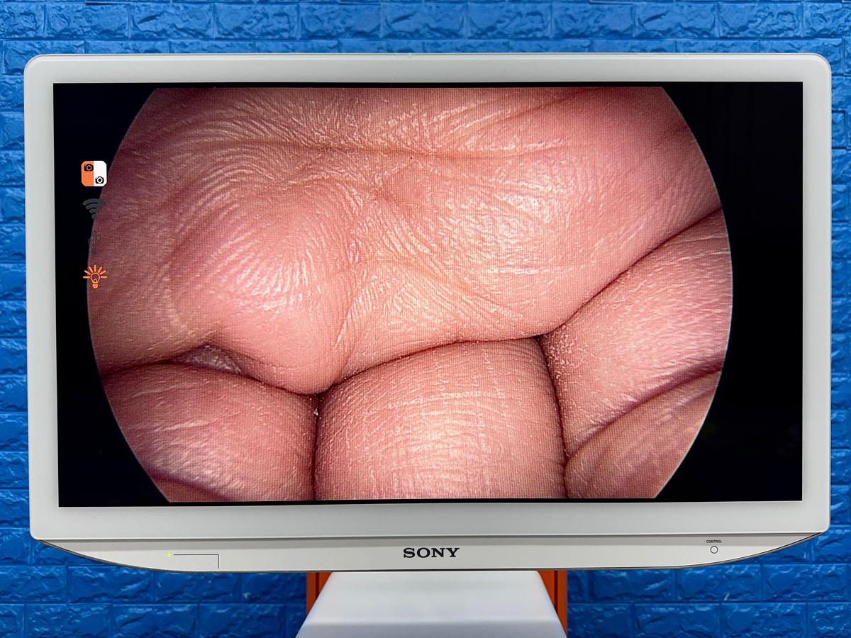 Used Smith & Nephew System Sony LED Monitor 26 Inch YOM: 2018 Smith & Nephew 660HD-E Image Management System YOM: 2021 Smith & Nephew LENS Integrated HD System YOM: 2018  Karl Storz Electronic Endoflator 264305 20  Smith & Nephew HD Camera Head 