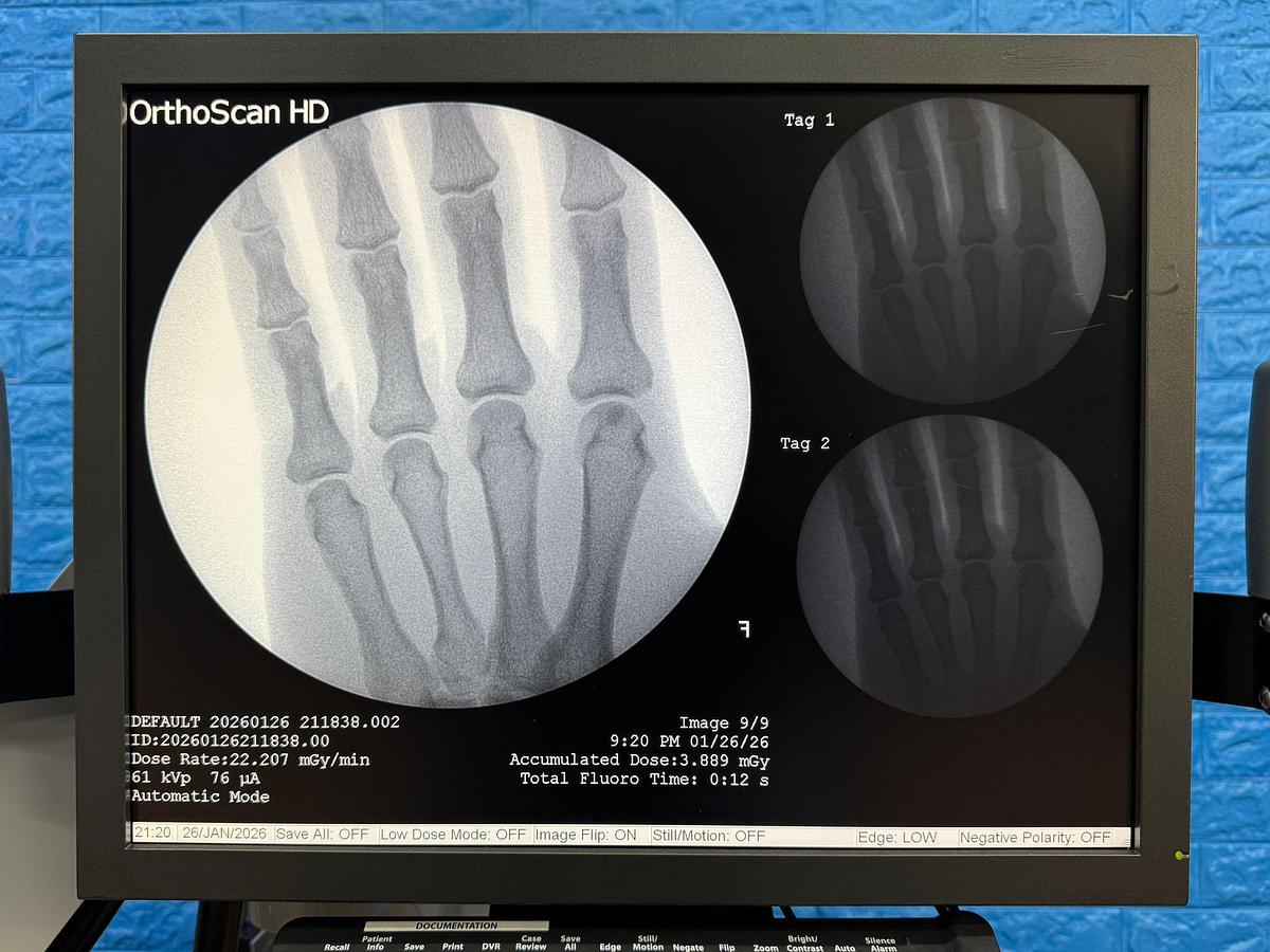 Used OrthoScan High Definition Mini C-Arm X-Ray Model: 1000-0004 YOM: 2011 SN: 5E1155