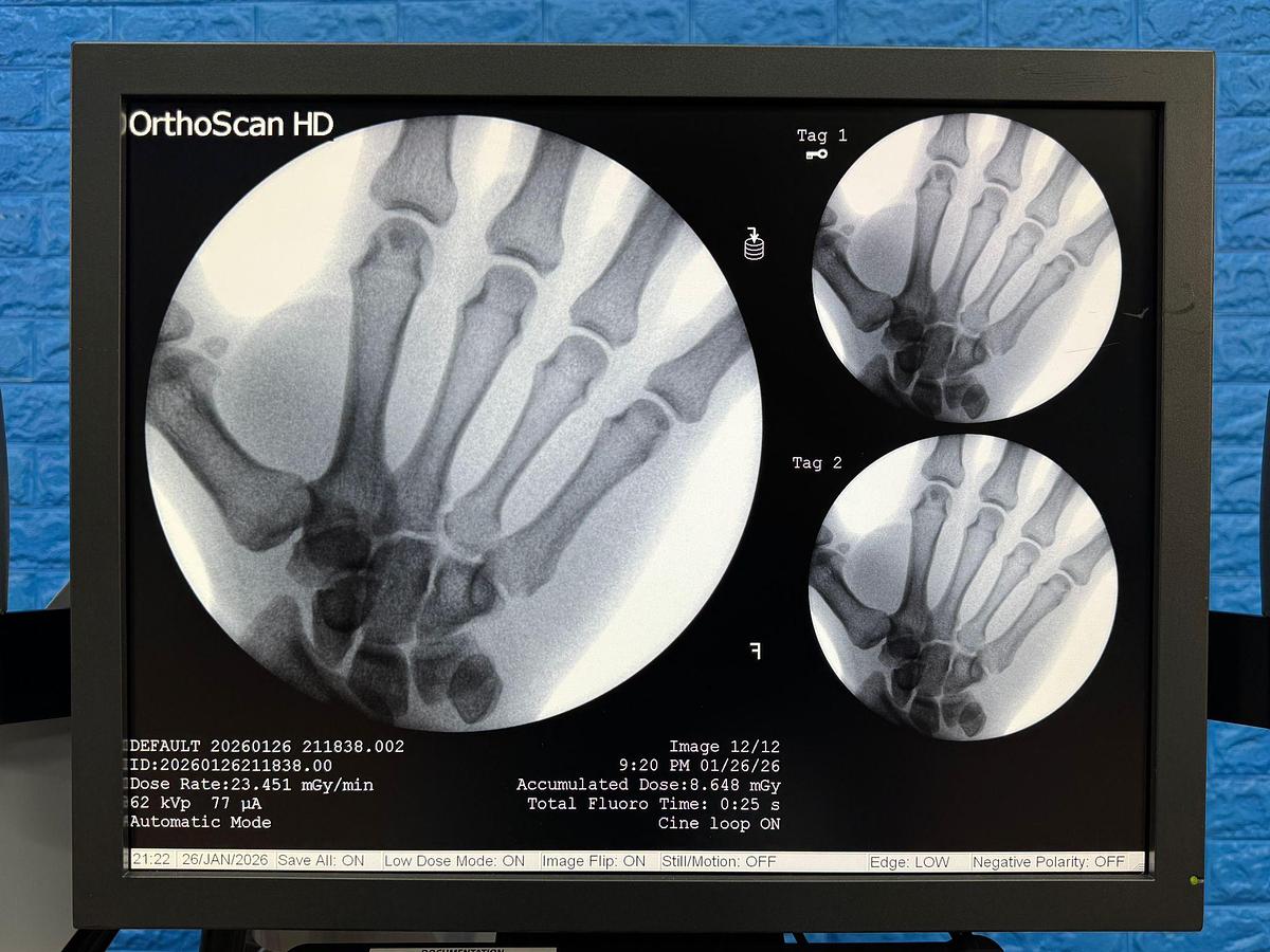 Used OrthoScan High Definition Mini C-Arm X-Ray Model: 1000-0004 YOM: 2011 SN: 5E1155