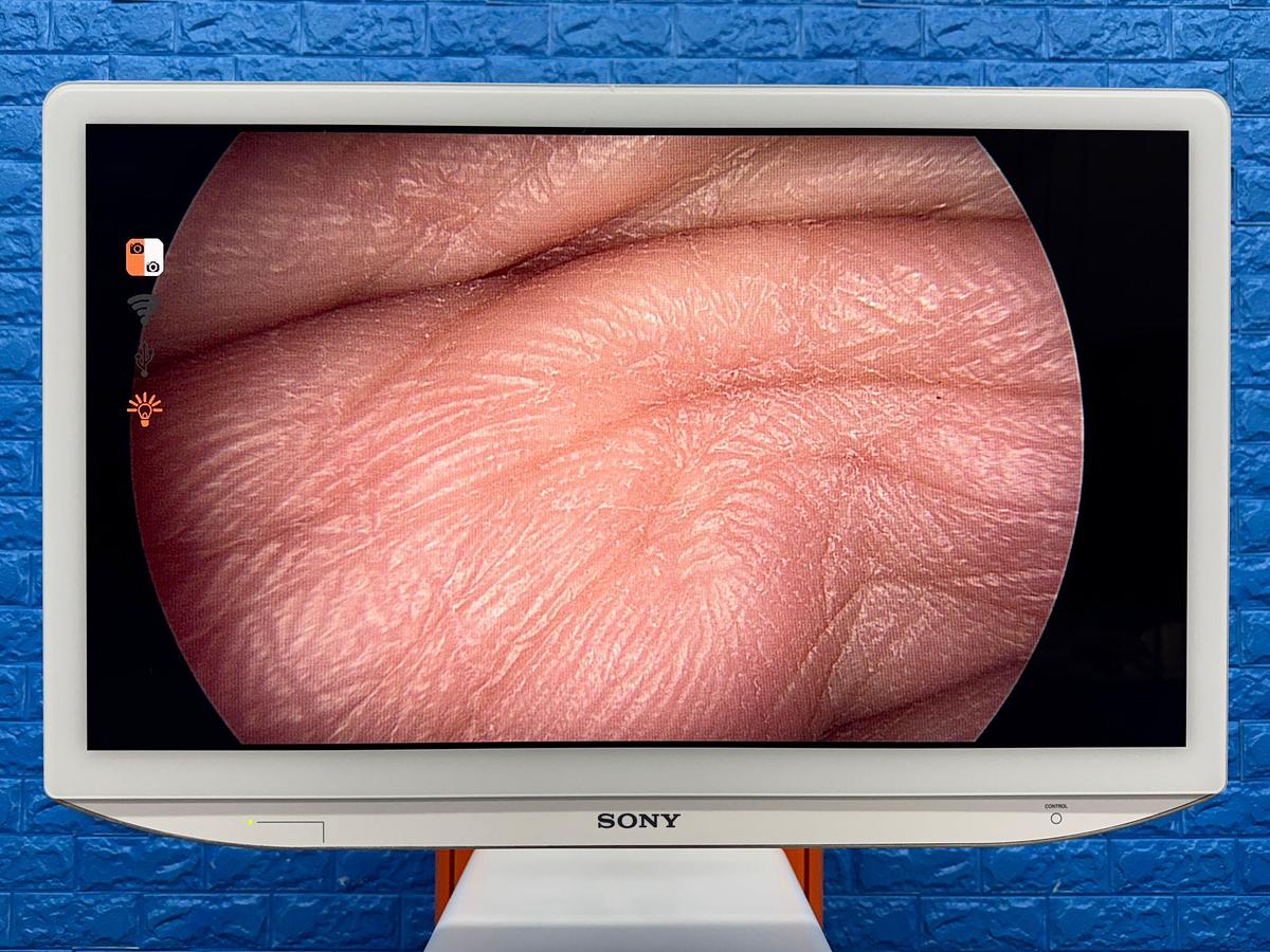 Used Smith & Nephew System Sony LED Monitor 26 Inch YOM: 2018 Smith & Nephew 660HD-E Image Management System YOM: 2021 Smith & Nephew LENS Integrated HD System YOM: 2018  Karl Storz Electronic Endoflator 264305 20  Smith & Nephew HD Camera Head 