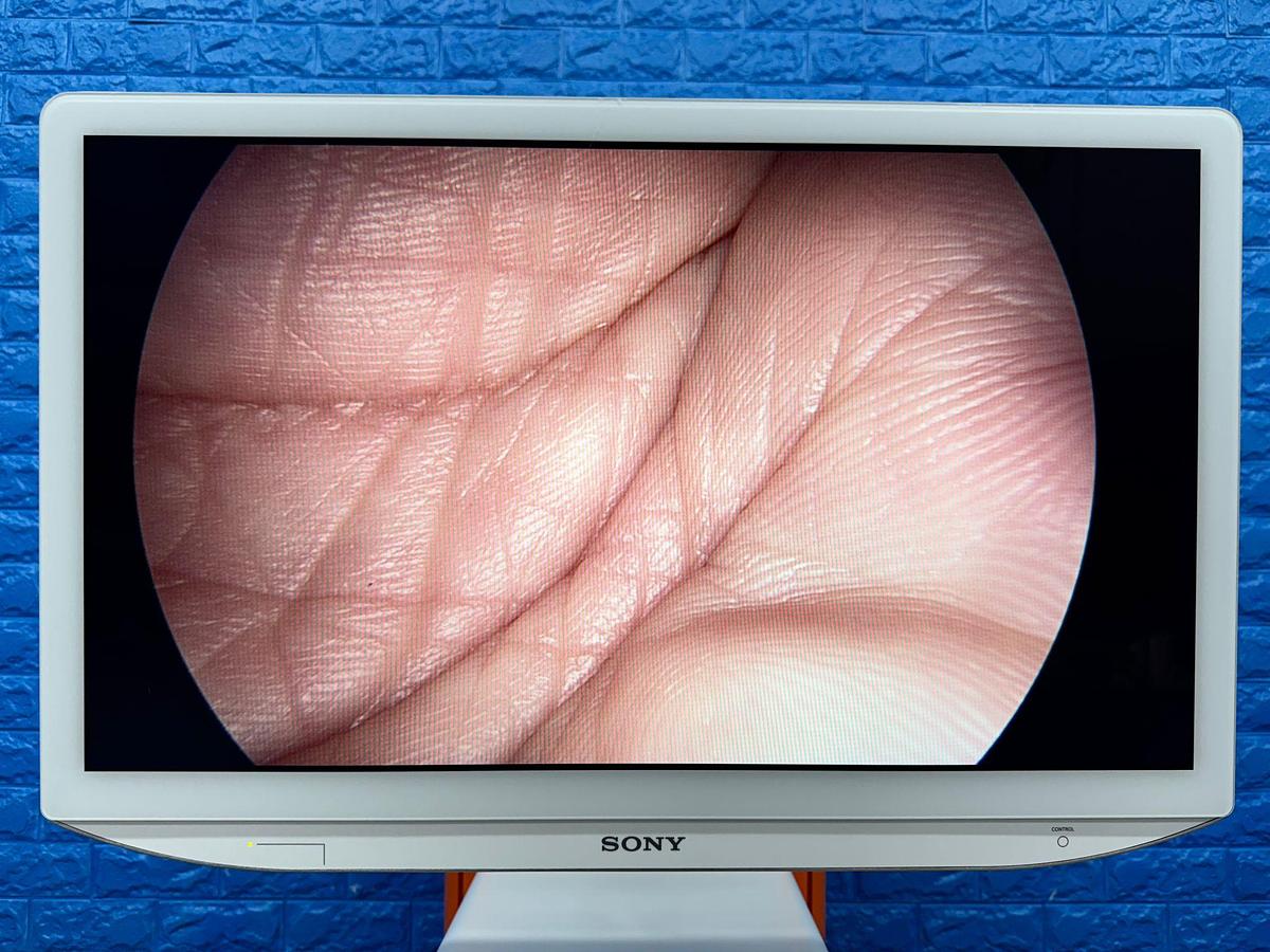 Used Smith & Nephew System Sony LED Monitor 26 Inch YOM: 2018 Smith & Nephew 660HD-E Image Management System YOM: 2021 Smith & Nephew LENS Integrated HD System YOM: 2018  Karl Storz Electronic Endoflator 264305 20  Smith & Nephew HD Camera Head 