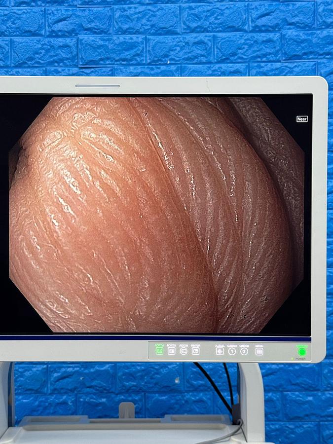 Used Olympus Evis X1 CV-1500 Endoscopy with Gastro GIF-HQ190 / Colono CF-HQ190L Includes: Olympus Evis X1 CV-1500 Processor Olympus MAJ-1921 Keyboard Olympus OFP-2 Flushing Pump Olympus UCR Gas Insufflator with hose Olympus MAJ-901 Water Bottle Olympus GIF-HQ190 Gastroscope with case and Air/Water/Suction valve Olympus CF-HQ190L Long Colonoscope with case and Air/Water/Suction valve