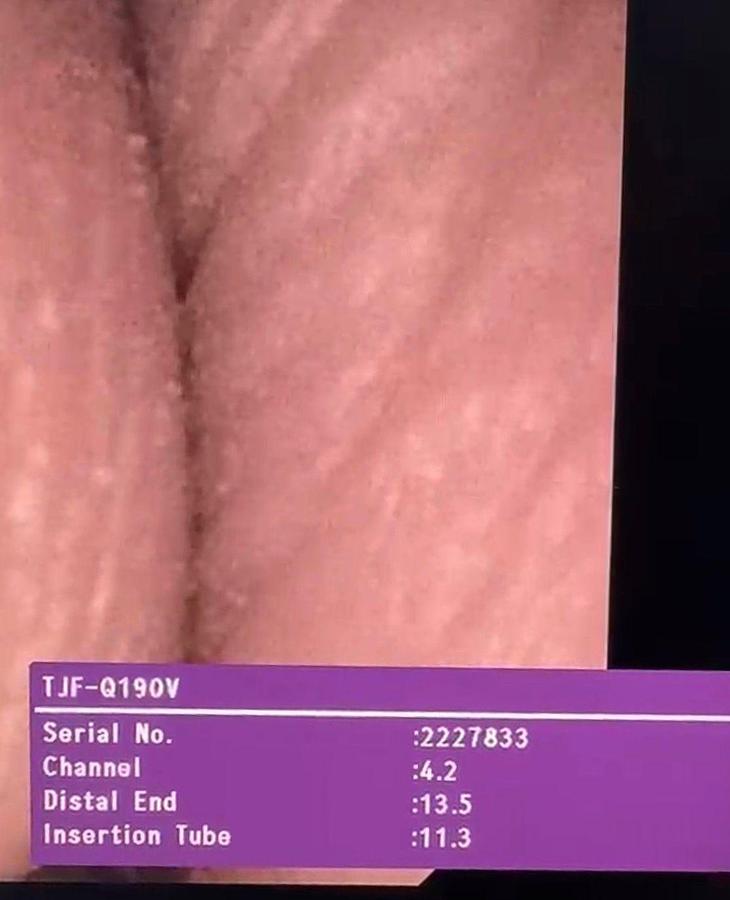 Used Olympus Scope Model: TJF-Q190V 